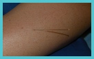 Acupunture